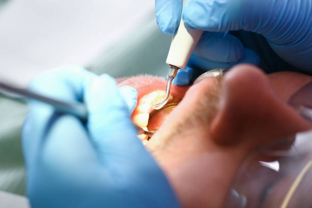 Best Knocked-Out Tooth (Avulsed Tooth) Treatment in Bridgewater, VA